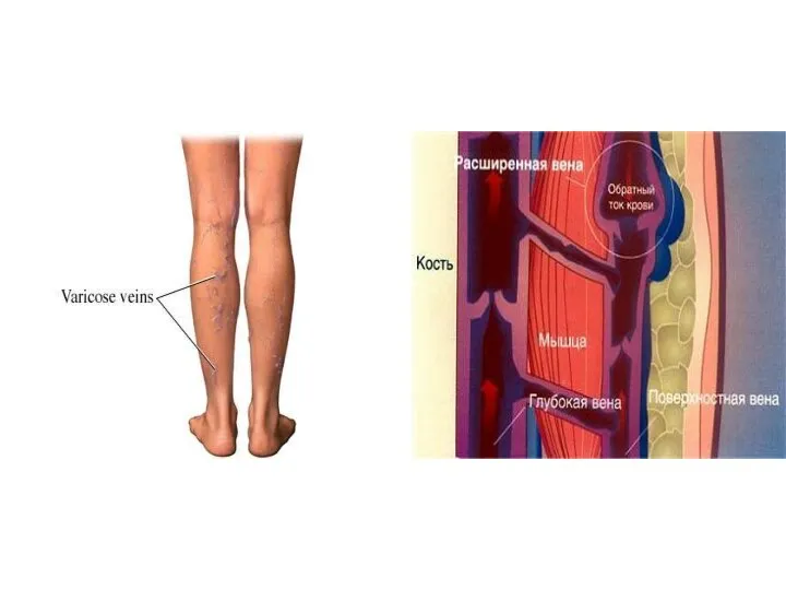 Варикозное расширение вен