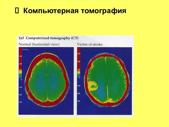 Компьютерная томография