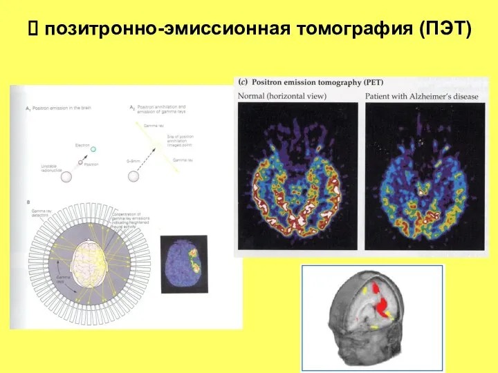 позитронно-эмиссионная томография (ПЭТ)