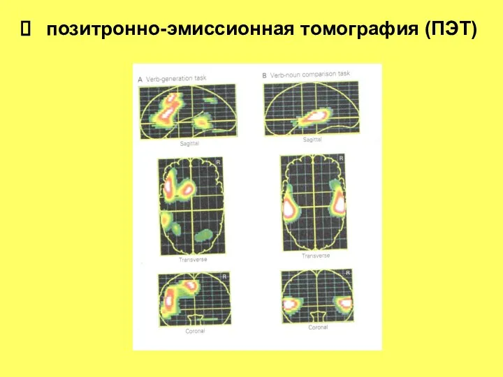 позитронно-эмиссионная томография (ПЭТ)