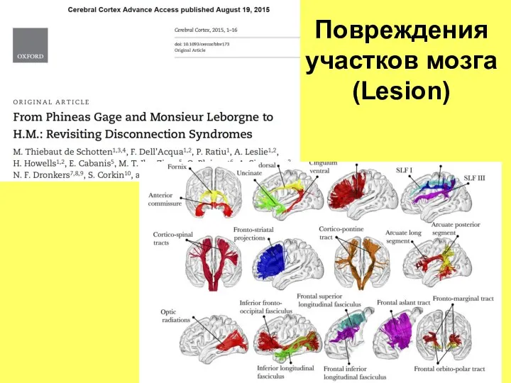 Повреждения участков мозга (Lesion)