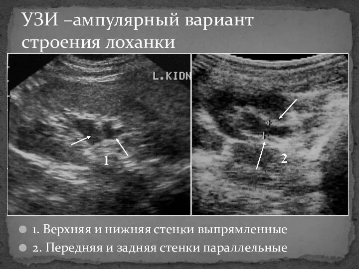 1. Верхняя и нижняя стенки выпрямленные 2. Передняя и задняя стенки