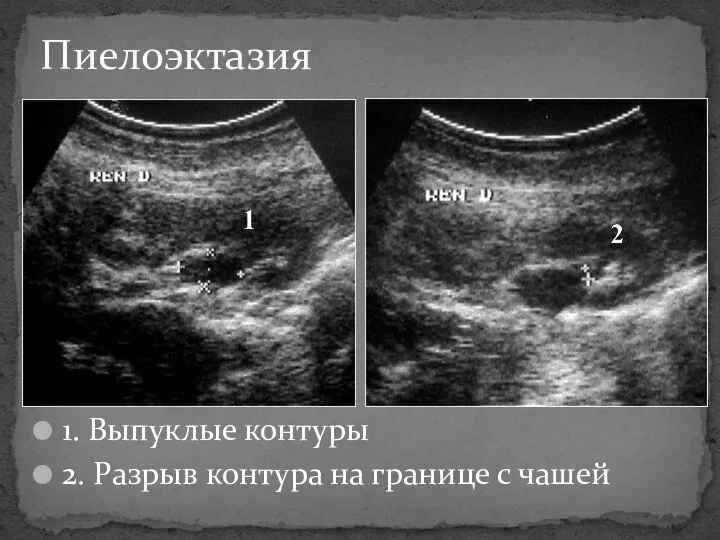 1. Выпуклые контуры 2. Разрыв контура на границе с чашей Пиелоэктазия