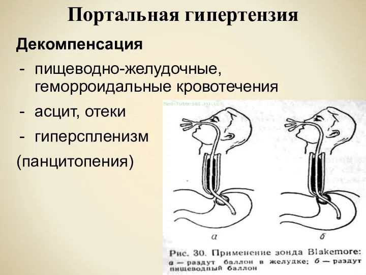 Портальная гипертензия Декомпенсация пищеводно-желудочные, геморроидальные кровотечения асцит, отеки гиперспленизм (панцитопения)