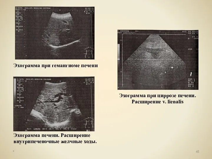 * Эхограмма при гемангиоме печени Эхограмма при циррозе печени. Расширение v.