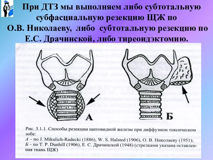 При ДТЗ мы выполняем либо субтотальную субфасциальную резекцию ЩЖ по О.В.
