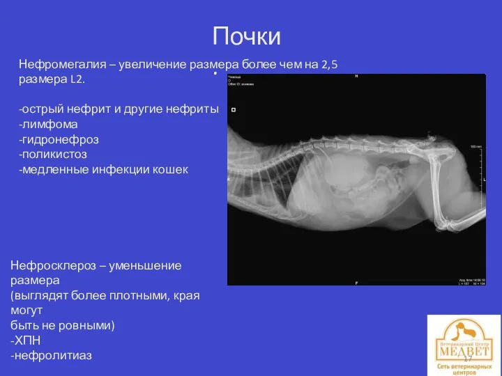 Почки. Нефромегалия – увеличение размера более чем на 2,5 размера L2.