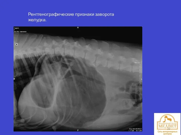 Рентгенографические признаки заворота желудка.