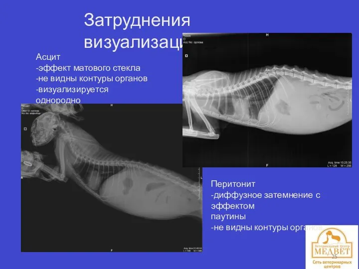 Затруднения визуализации. Асцит -эффект матового стекла -не видны контуры органов -визуализируется