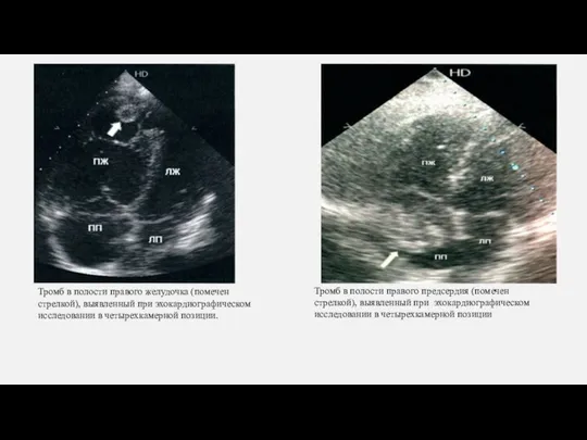 Тромб в полости правого желудочка (помечен стрелкой), выявленный при эхокардиографическом исследовании