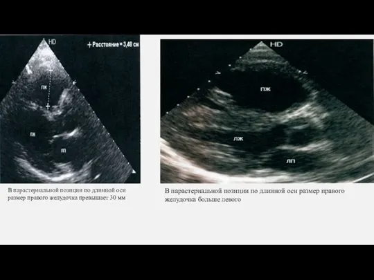 В парастернальной позиции по длинной оси размер правого желудочка превышает 30