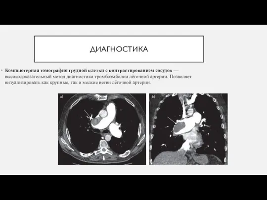 ДИАГНОСТИКА Компьютерная томография грудной клетки с контрастированием сосудов — высокодоказательный метод