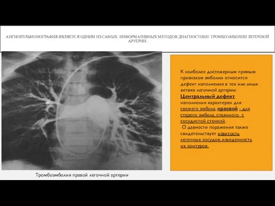 АНГИОПУЛЬМОНОГРАФИЯ ЯВЛЯЕТСЯ ОДНИМ ИЗ САМЫХ ИНФОРМАТИВНЫХ МЕТОДОВ ДИАГНОСТИКИ ТРОМБОЭМБОЛИИ ЛЕГОЧНОЙ АРТЕРИИ.