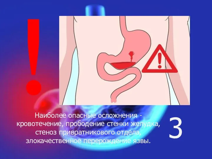 Наиболее опасные осложнения - кровотечение, прободение стенки желудка, стеноз привратникового отдела, злокачественное перерождение язвы. 3 !