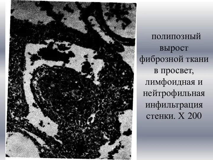 полипозный вырост фиброзной ткани в просвет, лимфоидная и нейтрофильная инфильтрация стенки. Х 200