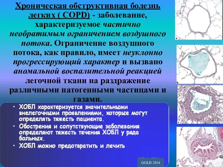 Хроническая обструктивная болезнь легких ( COPD) - заболевание, характеризуемое частично необратимым