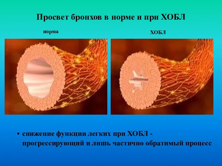 Просвет бронхов в норме и при ХОБЛ норма ХОБЛ снижение функции