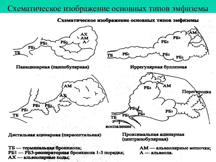 Схематическое изображение основных типов эмфиземы