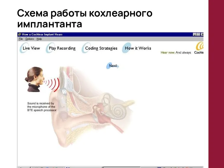 Схема работы кохлеарного имплантанта