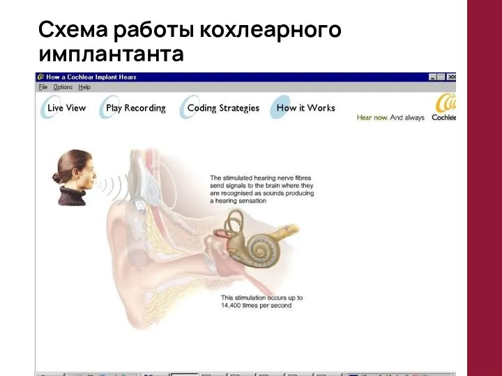 Схема работы кохлеарного имплантанта