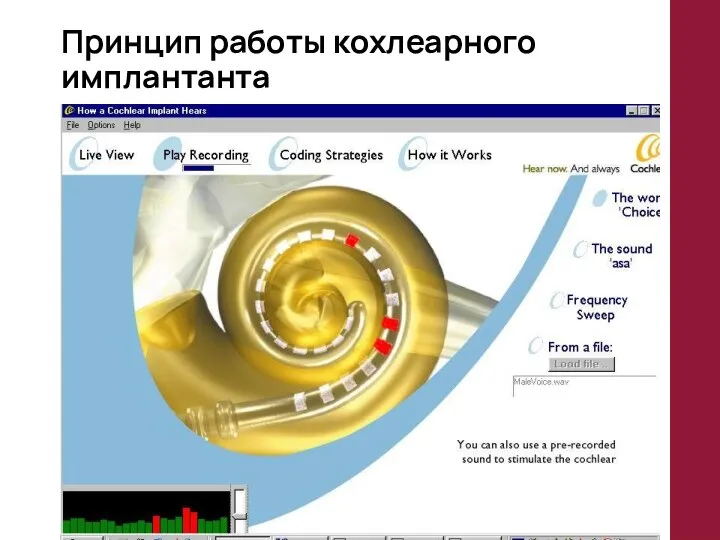 Принцип работы кохлеарного имплантанта