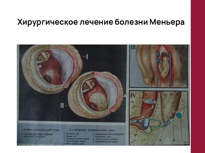 Хирургическое лечение болезни Меньера