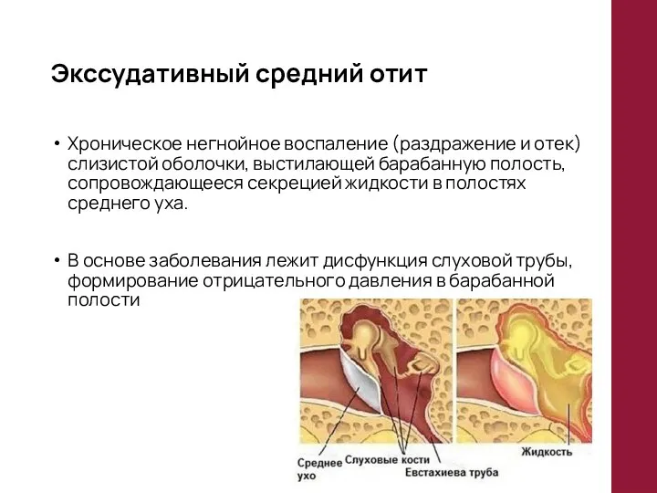 Экссудативный средний отит Хроническое негнойное воспаление (раздражение и отек) слизистой оболочки,