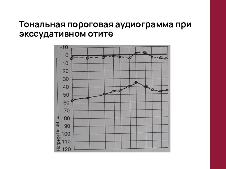 Тональная пороговая аудиограмма при экссудативном отите