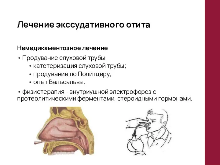 Лечение экссудативного отита Немедикаментозное лечение • Продувание слуховой трубы: • катетеризация