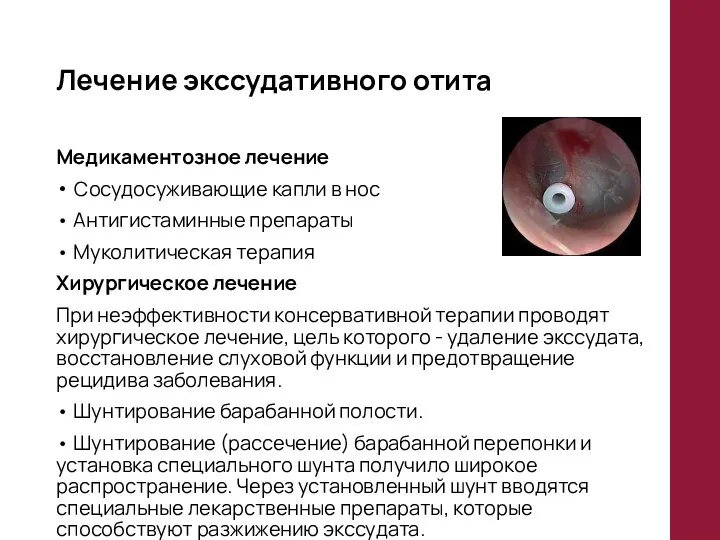 Лечение экссудативного отита Медикаментозное лечение Сосудосуживающие капли в нос • Антигистаминные