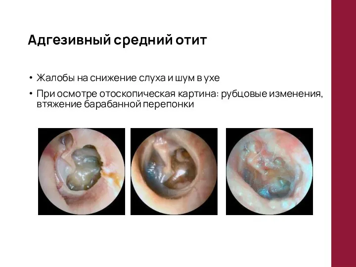 Адгезивный средний отит Жалобы на снижение слуха и шум в ухе