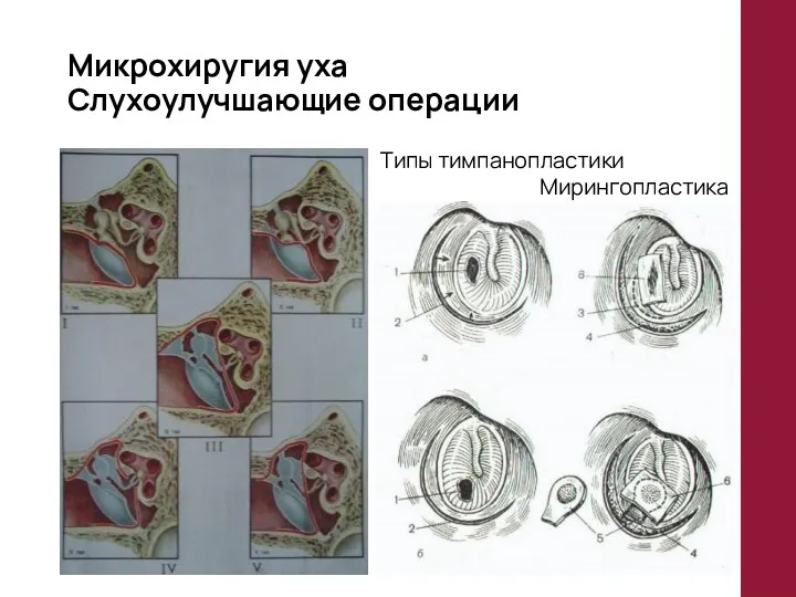 Микрохиругия уха Слухоулучшающие операции Типы тимпанопластики Мирингопластика