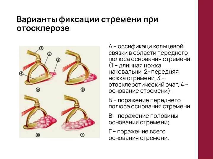 Варианты фиксации стремени при отосклерозе А – оссификаци кольцевой связки в