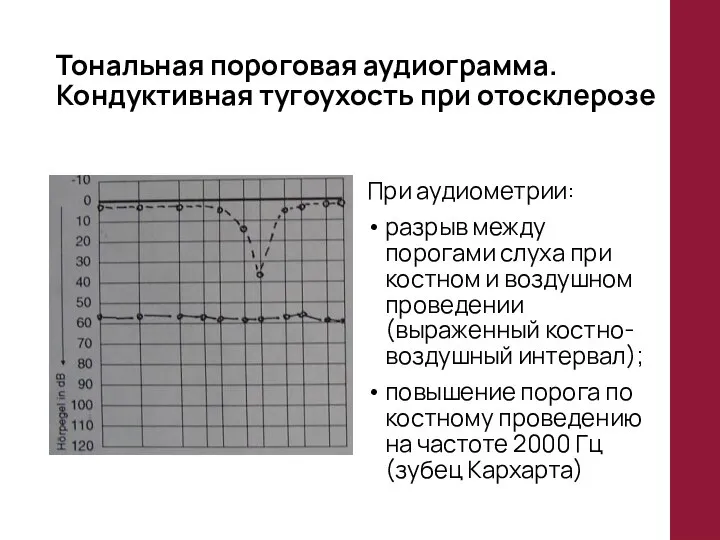 Тональная пороговая аудиограмма. Кондуктивная тугоухость при отосклерозе При аудиометрии: разрыв между