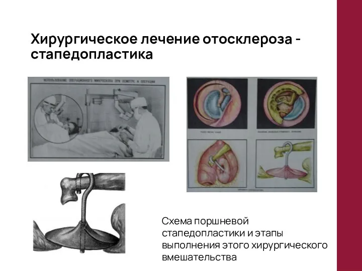 Хирургическое лечение отосклероза - стапедопластика Схема поршневой стапедопластики и этапы выполнения этого хирургического вмешательства