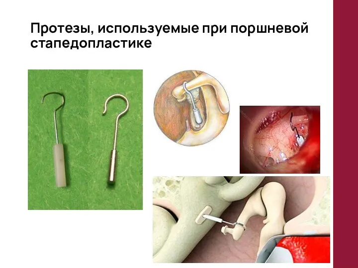 Протезы, используемые при поршневой стапедопластике