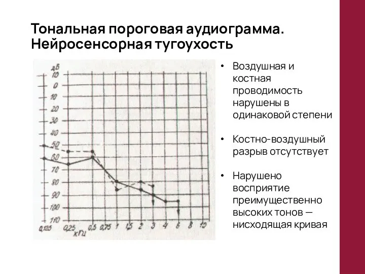 Тональная пороговая аудиограмма. Нейросенсорная тугоухость Воздушная и костная проводимость нарушены в