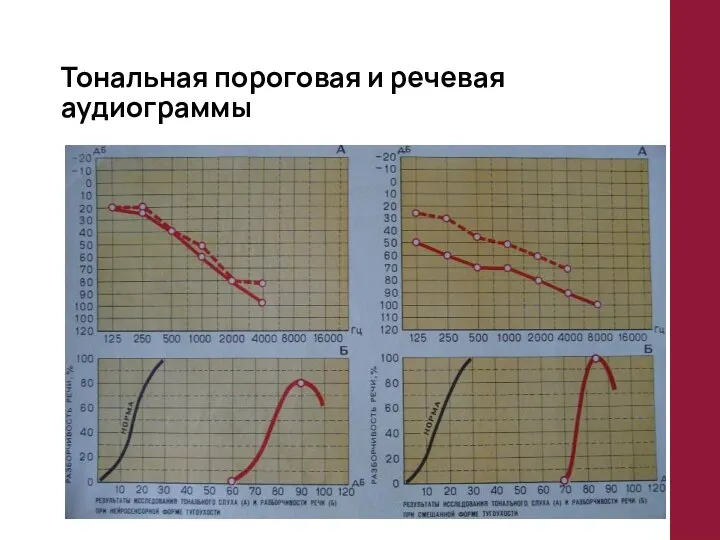 Тональная пороговая и речевая аудиограммы