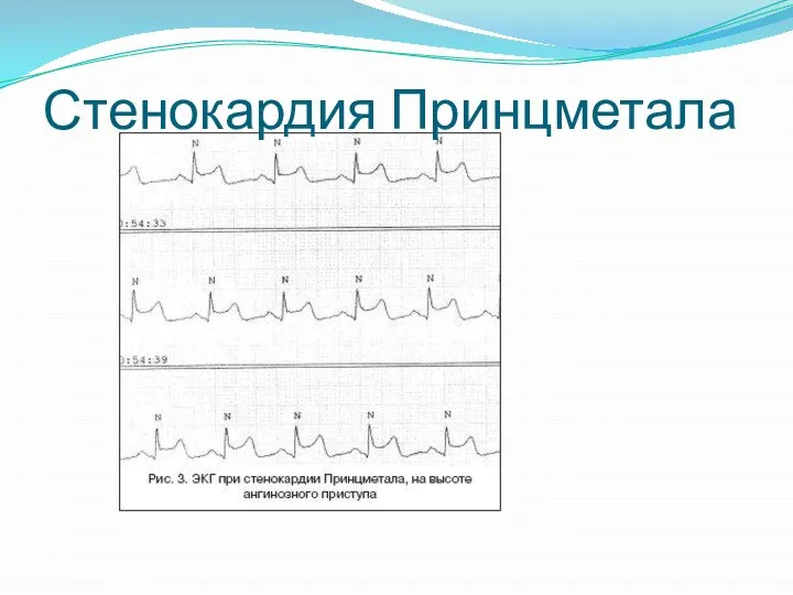 Стенокардия Принцметала