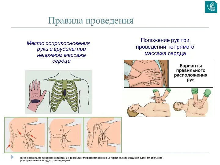 Правила проведения Место соприкосновения руки и грудины при непрямом массаже сердца