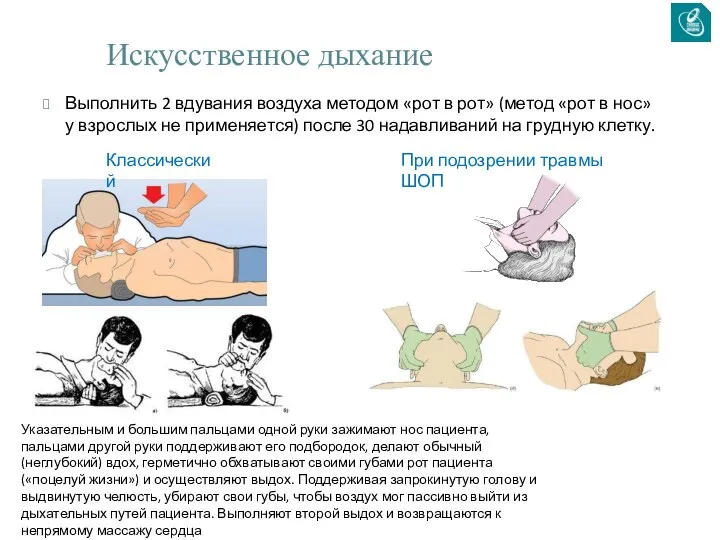 Искусственное дыхание Выполнить 2 вдувания воздуха методом «рот в рот» (метод