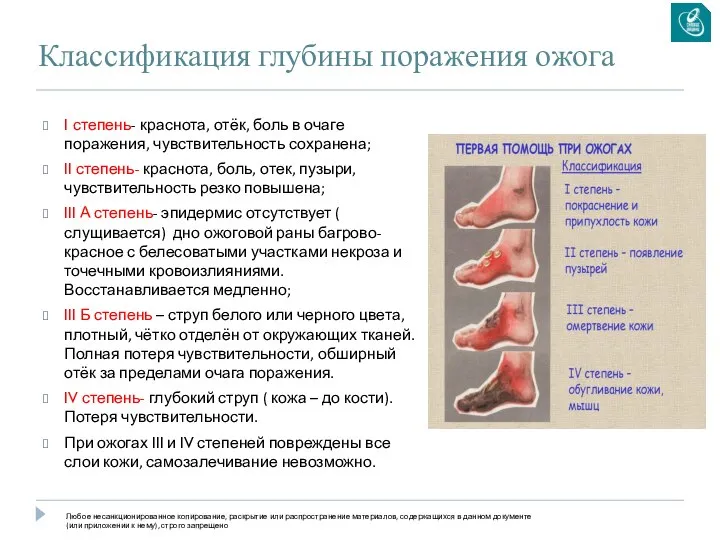 Классификация глубины поражения ожога I степень- краснота, отёк, боль в очаге