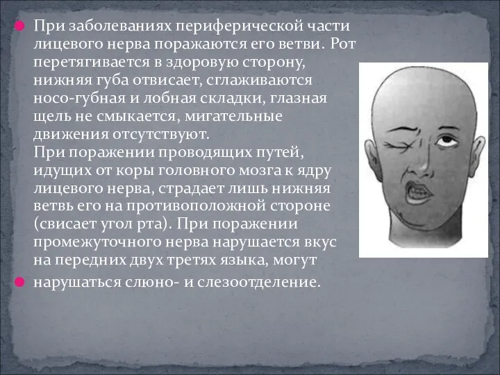 При заболеваниях периферической части лицевого нерва поражаются его ветви. Рот перетягивается