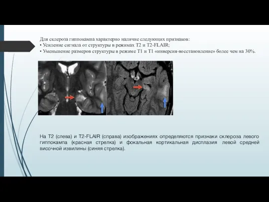 Для склероза гиппокампа характерно наличие следующих признаков: • Усиление сигнала от