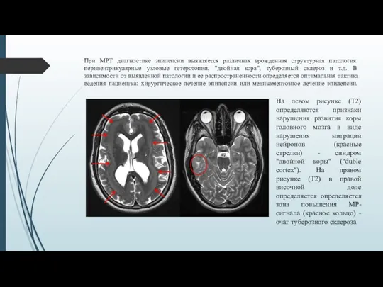 При МРТ диагностике эпилепсии выявляется различная врожденная структурная патология: перивентрикулярные узловые