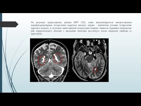 На рисунках представлены данные МРТ (Т2): слева визуализируются множественные перивентрикулярные гетеротопии