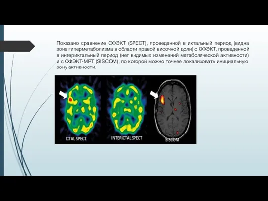 Показано сравнение ОФЭКТ (SPECT), проведенной в иктальный период (видна зона гиперметаболизма