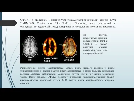 ОФЭКТ с введением Технеция-99м гексаметилпропиленамин оксима (99m Tc-HMPAO, Ceretec или 99m