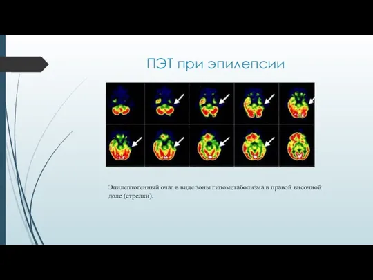 ПЭТ при эпилепсии Эпилептогенный очаг в виде зоны гипометаболизма в правой височной доле (стрелки).