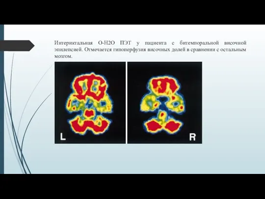 Интериктальная O-H2O ПЭТ у пациента с битемпоральной височной эпилепсией. Отмечается гипоперфузия
